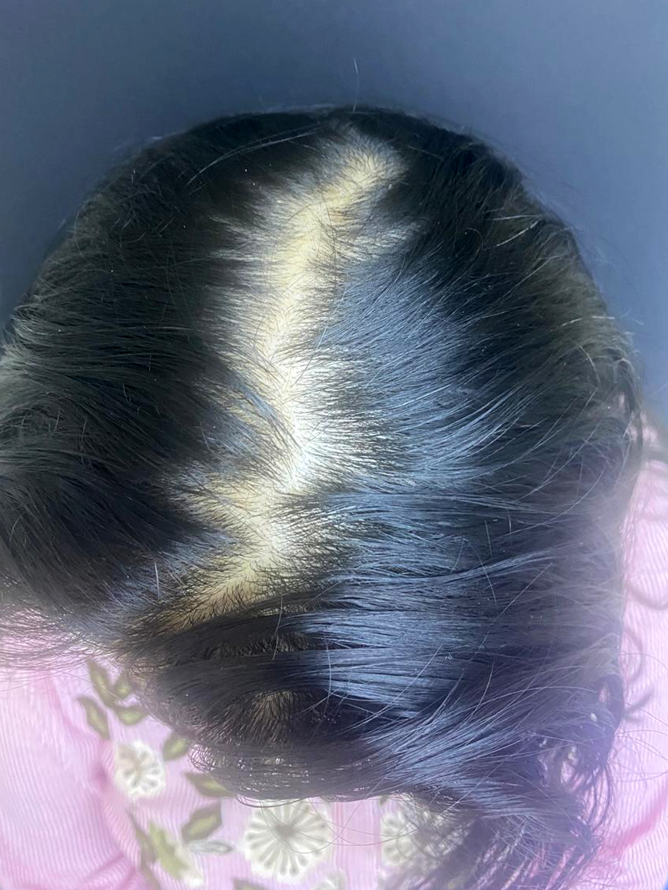Before treatment